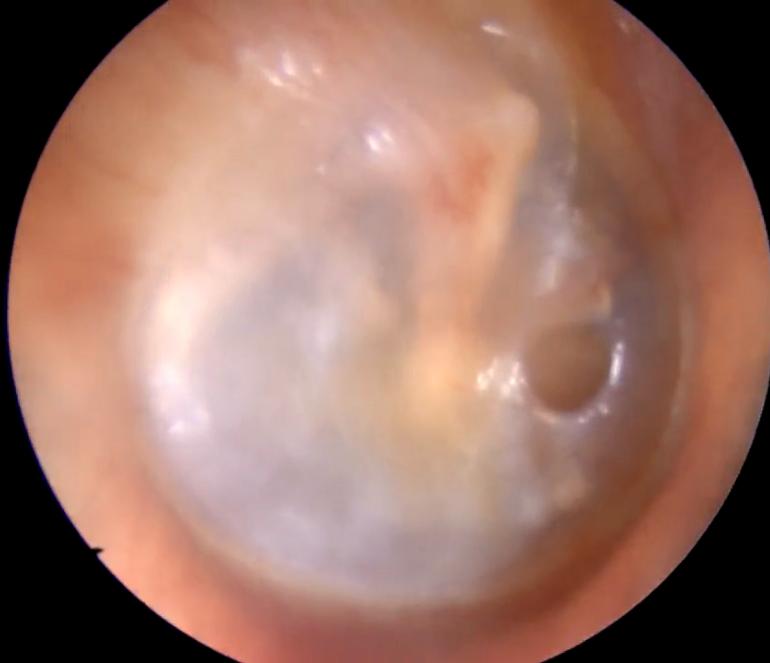 Imagem mostrando um timpano perfurado.
A cirurgia para correção de timpano perfurado resolve esse probelam