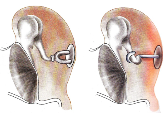imagem ilustrativa mostrando resultado da estapedotomia, a cirurgia para estapedotomia